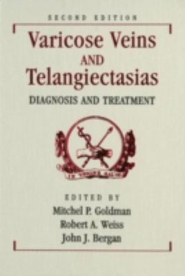 Varicose Veins and Telangiectasias Diagnosis and Treatment